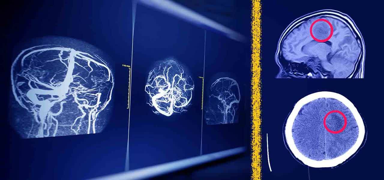 راه‌حل جدید پژوهشگران ایرانی برای افزایش امنیت هوش مصنوعی در تحلیل MRI مغز