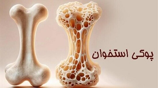 چطور با غذا جلوی «پوکی استخوان» را بگیریم؟